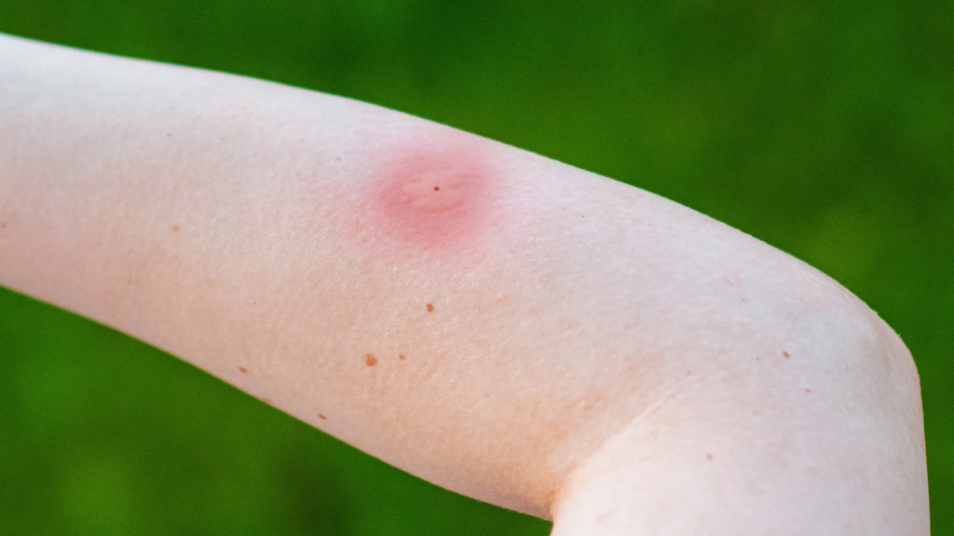 A young individual is showing a bite mark that has been caused by an insect. They have not protected themselves with insect repellent and have not treated the bite with a relief product.