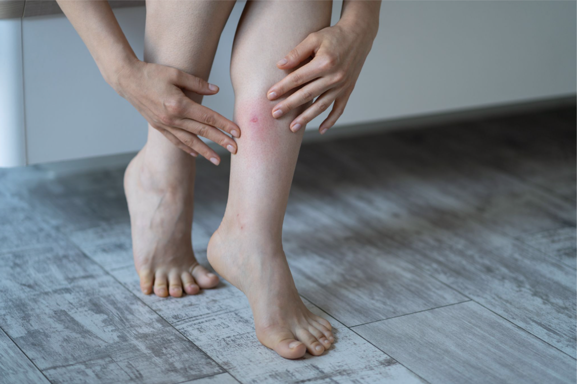 a woman touching her leg after being bitten by a horsefly.