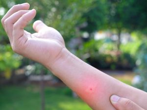 In a garden, a person examines an insect bite on their forearm.