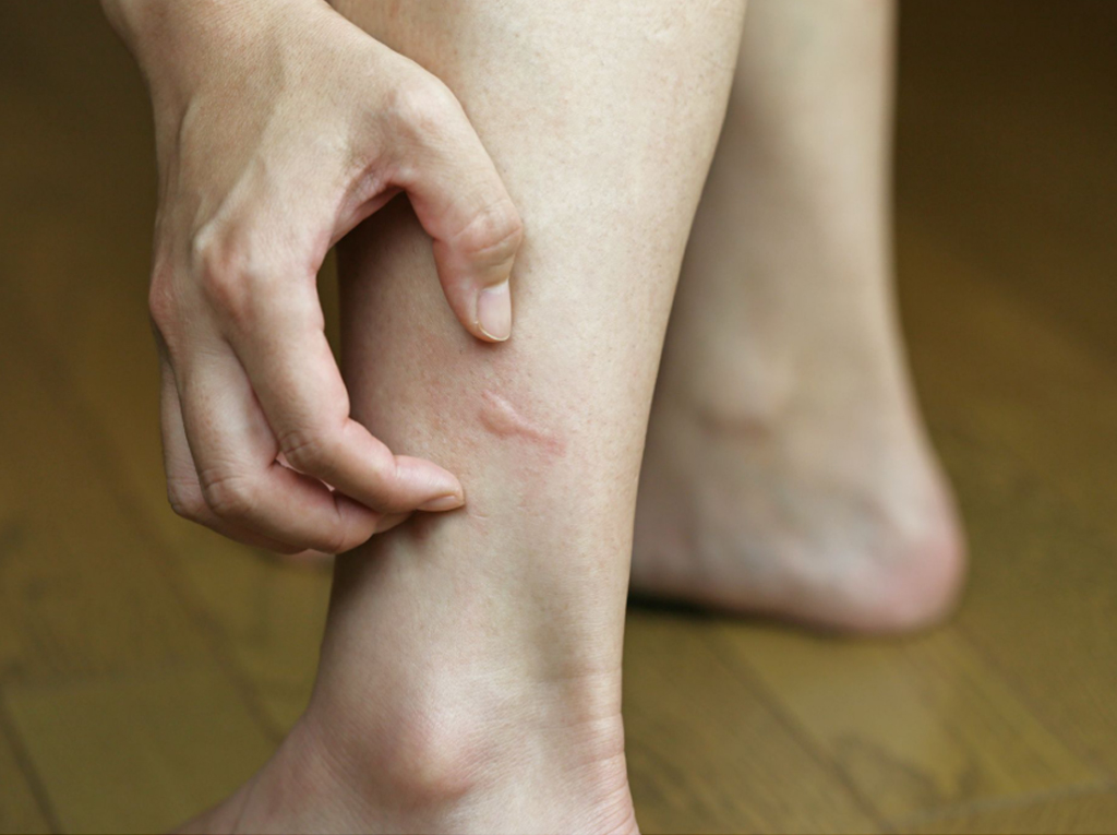 a hand itching a small raised insect bite welt on near their ankle.